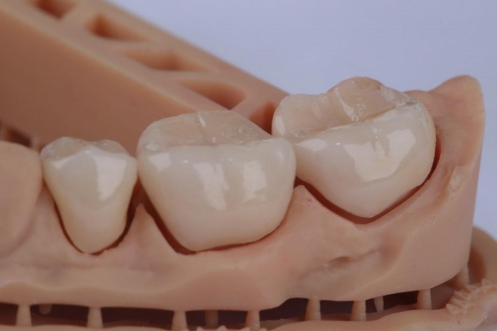 Выпрямление зубов при помощи 3D-технологий: будущее ортодонтии